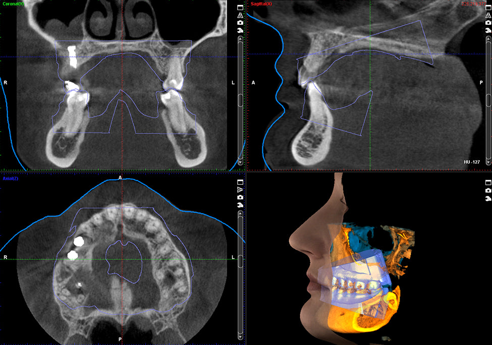 Planmeca Promax 3D Mid CBCT Imaging System